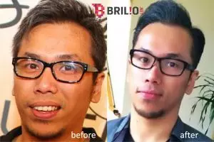 17 Foto perubahan Sammy Simorangkir, jadi ganteng dan digosipin oplas!