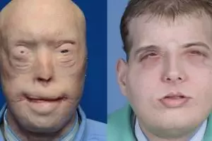 Operasi wajah terluas sepanjang sejarah sukses dilakukan