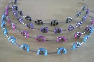 Pakai behel cuma buat gaya-gayaan bahaya nggak sih? Ini penjelasannya