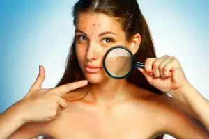 12 Cara alami menghilangkan jerawat yang membandel, dijamin ampuh!