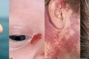 10 Macam tanda lahir dan arti buat kesehatan, kamu punya nggak?