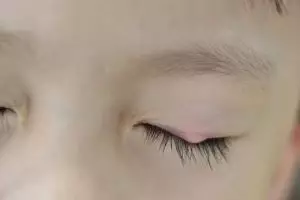 Mata kamu bintitan? Ini cara ampuh dan sederhana mengobatinya