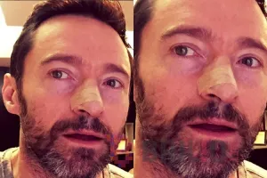 Hidung Hugh Jackman diplester, kenapa ya?