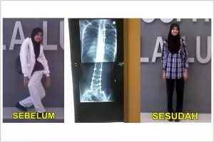 Beruntungnya gadis ini, kakinya kembali tegap usai operasi 3 tahun