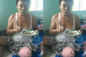 Ingin kembali beraktivitas, Rozali butuh bantuan kaki palsu