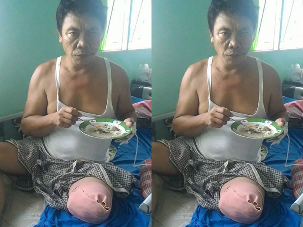 Ingin kembali beraktivitas, Rozali butuh bantuan kaki palsu