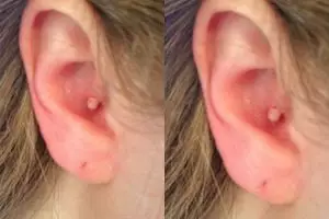 Ini alasan nggak boleh mencetin jerawat di telinga!