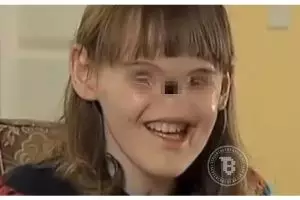 Lahir tanpa hidung & mata, gadis ini tetap mampu berprestasi