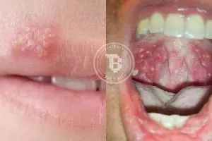 8 Penyakit ini bisa kamu idap cuma gara-gara ciuman bibir, bahaya nih!