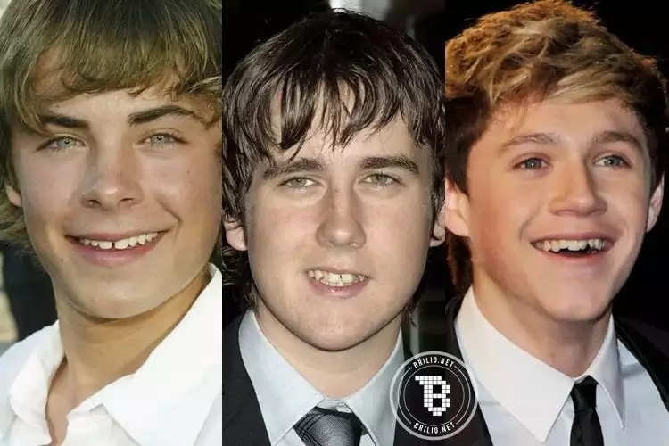 Before-After 15 selebriti yang pernah permak gigi, makin kece nggak? 