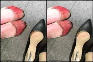 Kerja seharian pakai sepatu hak tinggi, kaki wanita ini mandi darah
