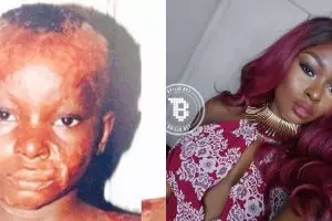 Luka bakar di seluruh wajah, wanita ini sukses jadi beauty blogger