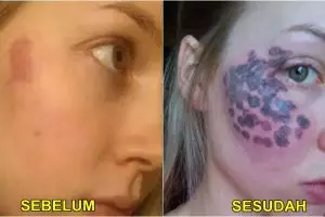 Bukannya hilang, tanda lahir di pipi gadis ini kian parah usai operasi