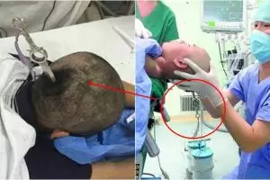 Gara-gara teman berantem, kepala gadis ini malah tertancap pisau!