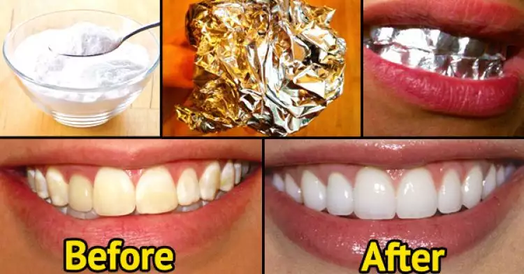 Ternyata memutihkan gigi bisa pakai aluminium foil, kamu berani coba?