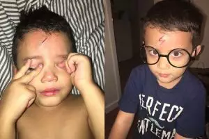 Ibu ini jempolan banget, ubah luka anak jadi mirip tanda Harry Potter