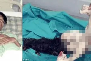 Remaja ini tak diduga mengandung saudara kembarnya selama 15 tahun