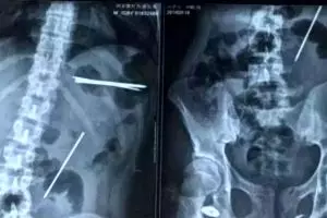 8 Paku sepanjang 15 cm bersarang  dan menusuk perut pria ini, duh!