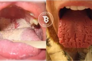 8 Kondisi lidah ini tunjukkan status kesehatanmu, yuk cek!