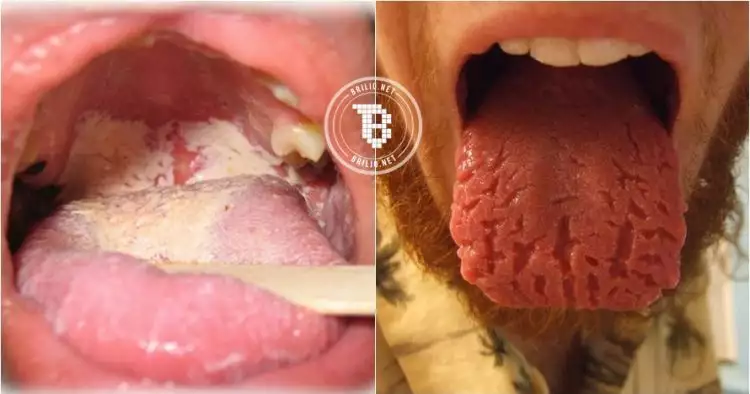 8 Kondisi lidah ini tunjukkan status kesehatanmu, yuk cek!