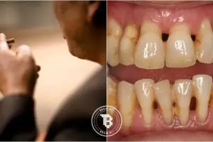 Tak hanya serang paru-paru, rokok juga bikin kamu kena penyakit mulut