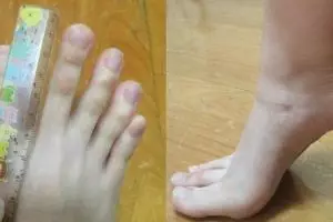 Mahasiswi berjari kaki 5 sentimeter ini hebohkan dunia maya
