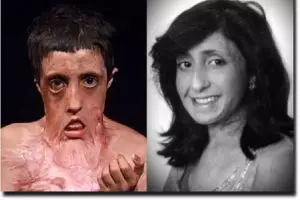 Bikin terenyuh, upaya gadis ini untuk cantik usai wajahnya terbakar