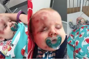 Tidak diimunisasi, sekujur tubuh bayi ini terserang campak mengerikan