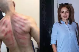 5 Selebriti ini hobi kerokan, wah wah masuk angin nih? 