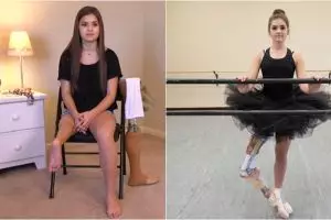 Satu kaki diamputasi, gadis cantik ini jadi penari balet berprestasi