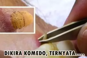 Dikira komedo, benda yang dikeluarkan dari kulit pria ini bikin kaget