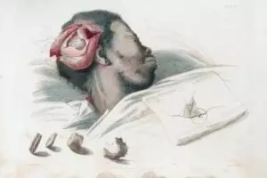 7 Pengobatan sadis bagi penderita gangguan jiwa zaman dulu, seram abis