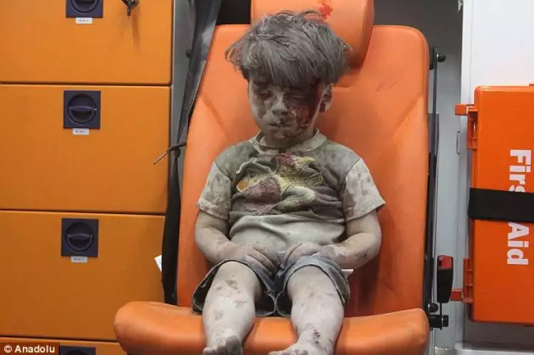 Kondisi bocah akibat konflik Suriah ini bikin meneteskan air mata