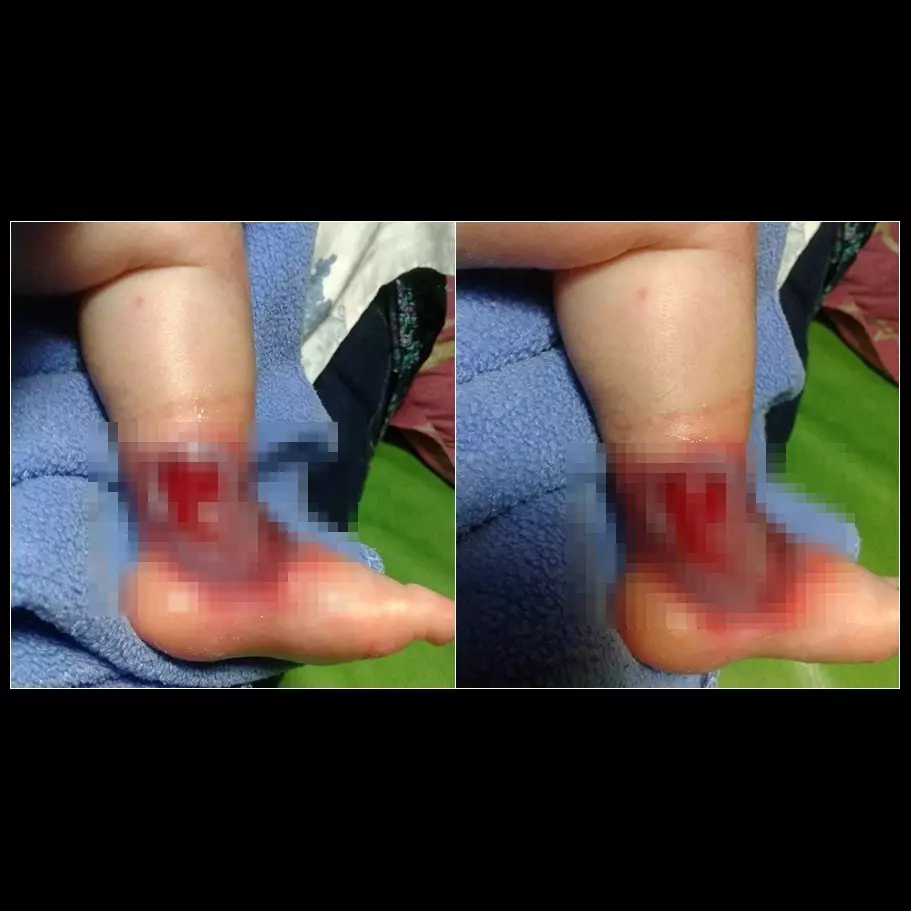 Diduga korban malpraktik, bayi ini alami infeksi serius