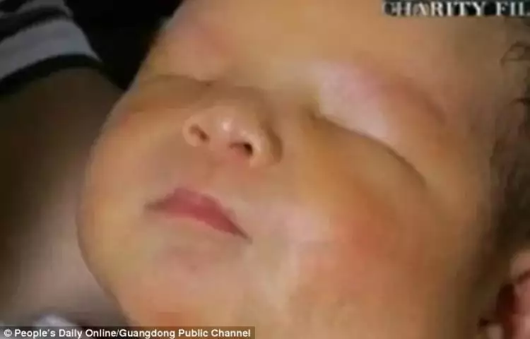 Bayi mungil nan menggemaskan ini lahir tanpa mata