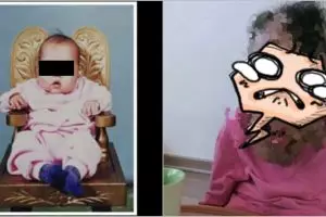 Wanita idap penyakit langka ini bikin netizen ramai salurkan donasi