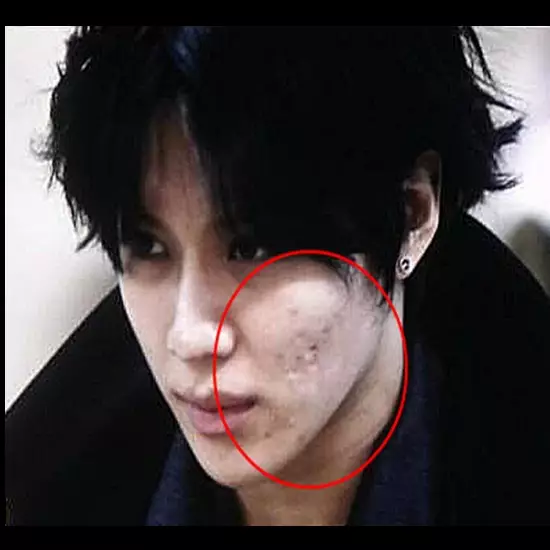 Nggak perlu resah, jerawat ternyata bikin kamu terlihat awet muda