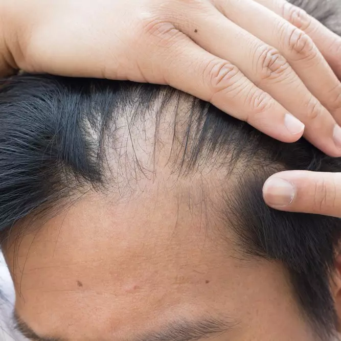 Dua per tiga cowok mulai botak di usia muda, ini penyebabnya