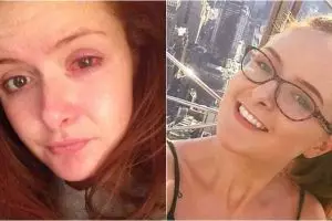 Kornea mata gadis ini robek akibat 10 jam non-stop pakai lensa kontak