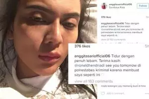 Akui lebam karena habis dipukul, Anggita Sari malah diledek netizen