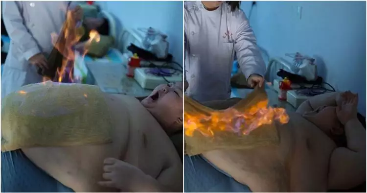 Punya berat 150 kg, bocah 11 tahun ini jalani terapi dengan dibakar