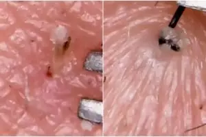 Video blackhead komedo yang berhasil dicabut, menjijikkan ya?