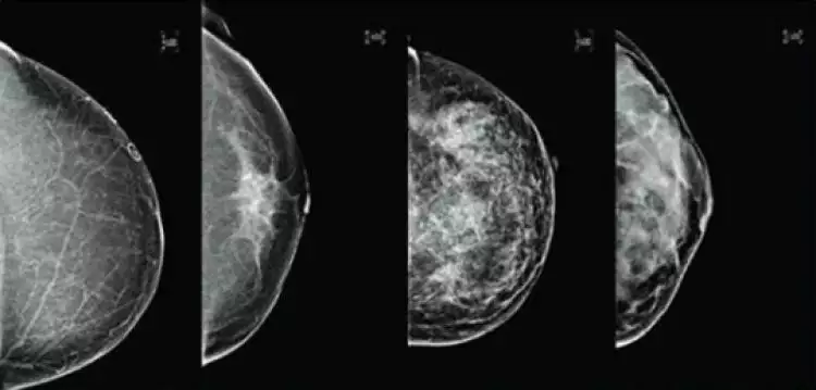 Teknologi terbaru ultrasonik lebih akurat deteksi kanker payudara