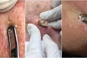 10 Video jerawat & komedo berhasil dicabut ini bikin puas ngelihatnya