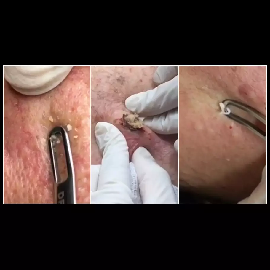 10 Video jerawat &amp; komedo berhasil dicabut ini bikin puas ngelihatnya