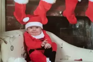 Menyedihkan, bayi ini kerap diejek 'bayi dalmatian' karena penyakitnya