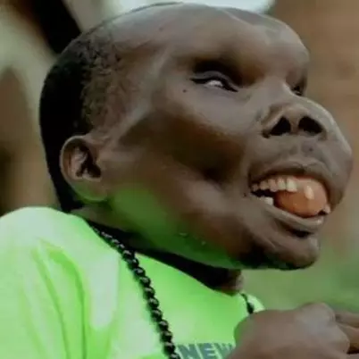 Ini kabar terbaru 'pria terjelek' di dunia, bikin nggak percaya