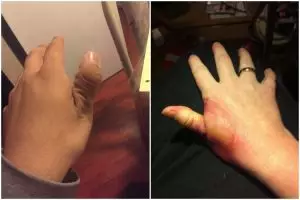 Jadi korban tantangan di medsos, jempol remaja ini jadi mengerikan