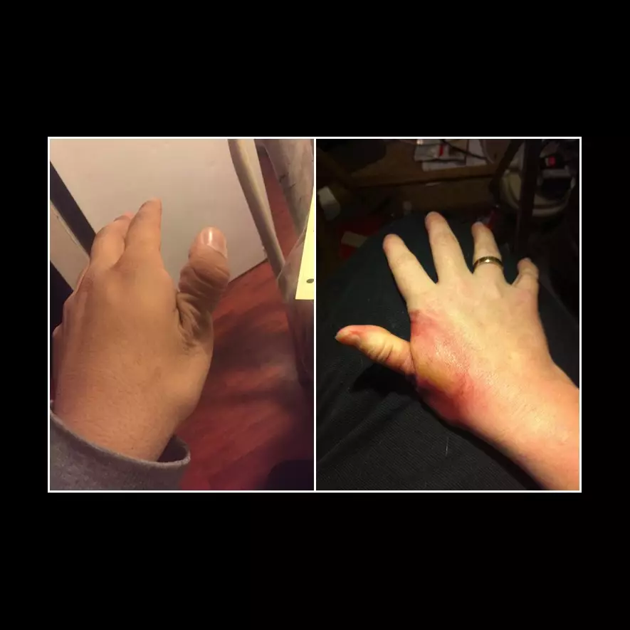 Jadi korban tantangan di medsos, jempol remaja ini jadi mengerikan