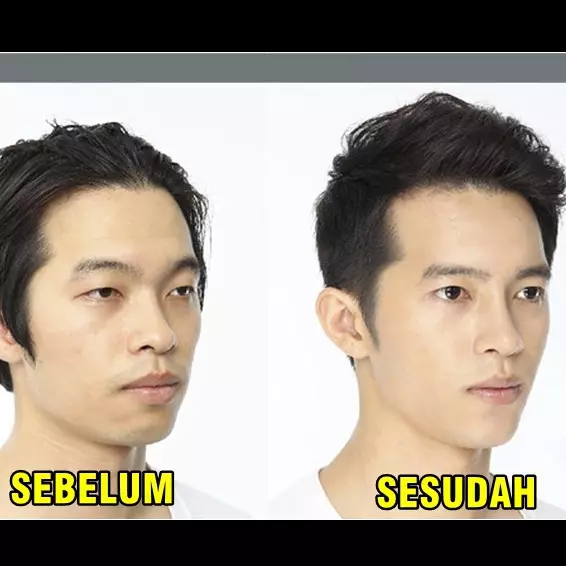 13 Foto before-after ini bukti kalau mau tampan instan pakai oplas